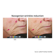 Wrinkle Filler Set