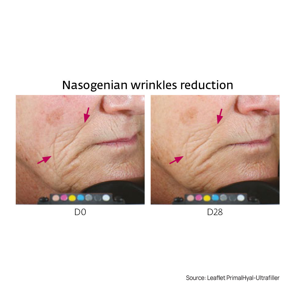 Wrinkle Filler Set