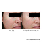 Wrinkle Filler Set