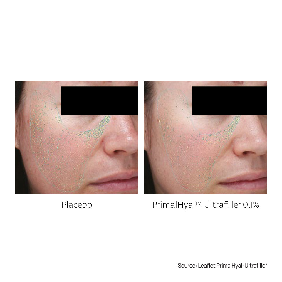 Wrinkle Filler Set